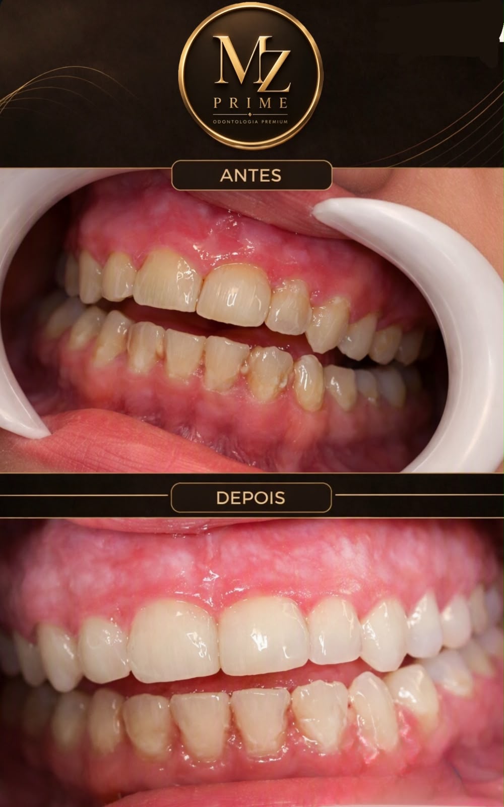 Resultado real antes e depois de tratamento na MZ Prime Odontologia