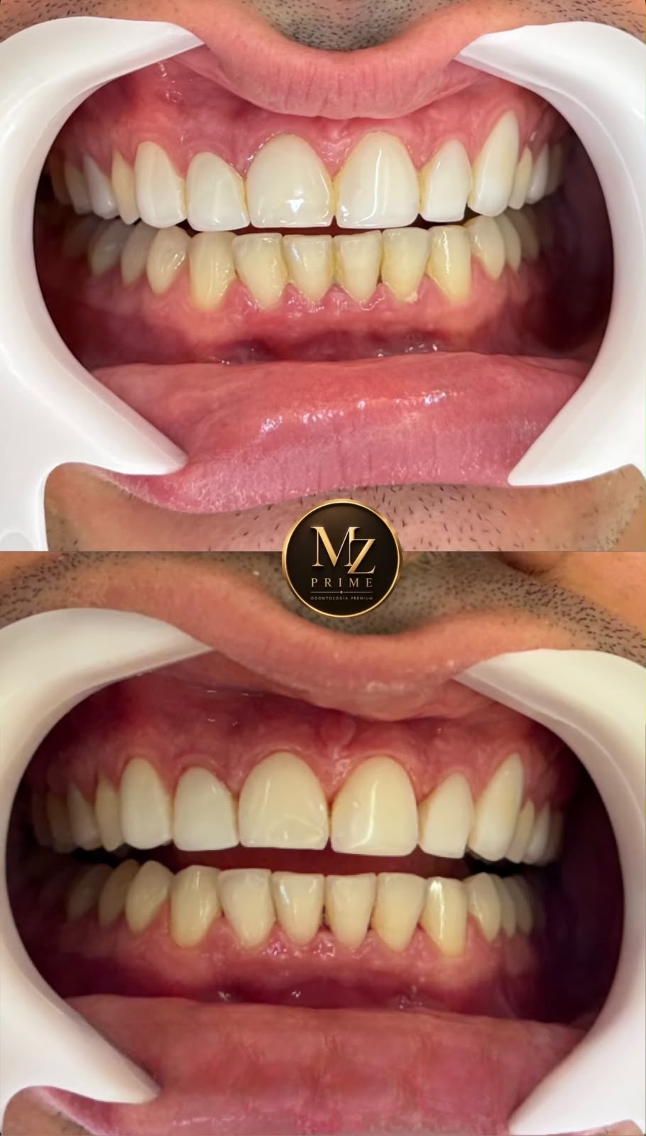 Resultado real antes e depois de tratamento na MZ Prime Odontologia